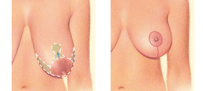 Anchor Breast Lift Incision