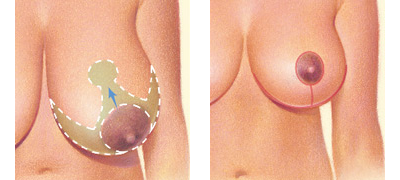 Anchor Incision for Breast Reduction