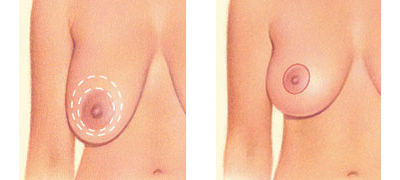 Doughnut Incision for Breast Lift