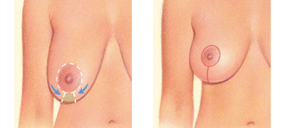 Lollipop Incision for Breast Lift