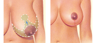 How Does Breast Reduction Restore Physical Comfort? - Westchester Surgical  Arts