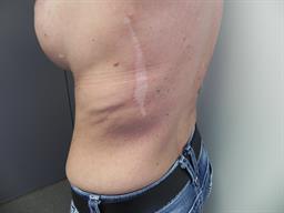 Latissimus Flap Reconstruction Back