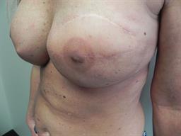 Latissimus Flap Reconstruction Healed