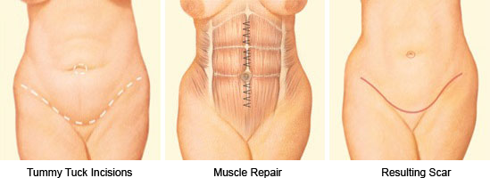 Tummy Tuck Lewisburg  Abdominoplasty Surgery in Near Me